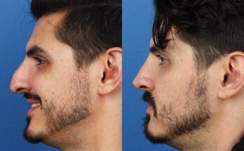 Rise of Rhinoplasty Among Men