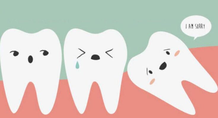 Truth About Third Molars