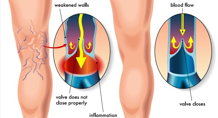 Understanding Venous Health