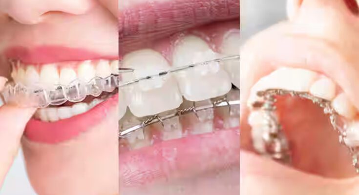 Dr. Aashish Mathesul: Pune's Leading Orthodontist for Invisalign Aligners