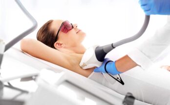 IPL Hair Removal Procedure