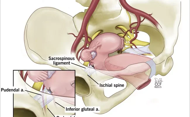 Pelvic Prolapse Surgery